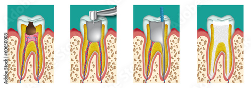 devitalization