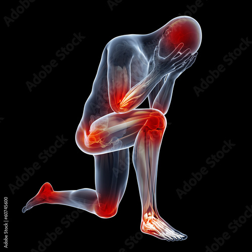medical illustration showing inflamed, painful joints
