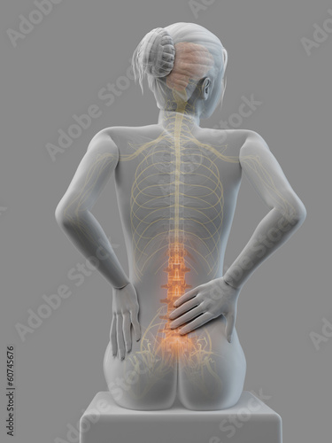 3d rendered medical illustration - Acute pain in a woman´s back.