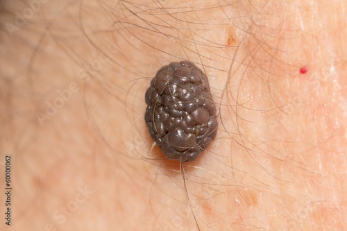 a mole on the skin. macro