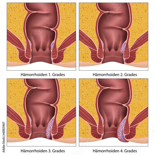 Hämorrhoiden Erkrankungsgrade