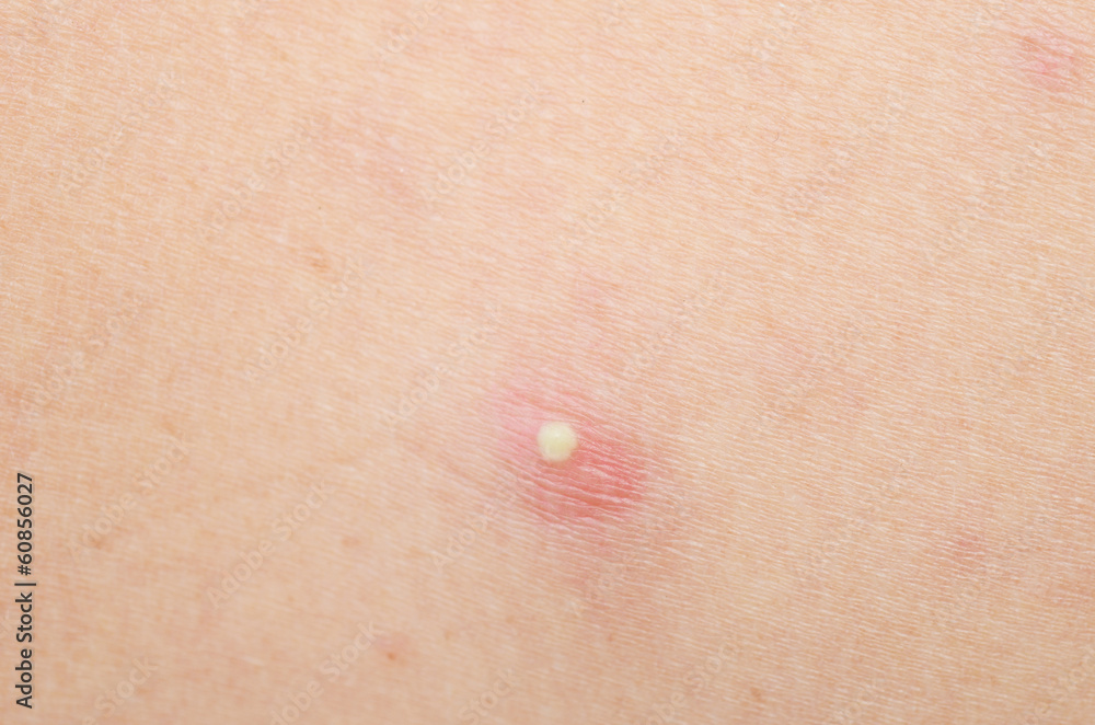 Fototapeta premium pimple
