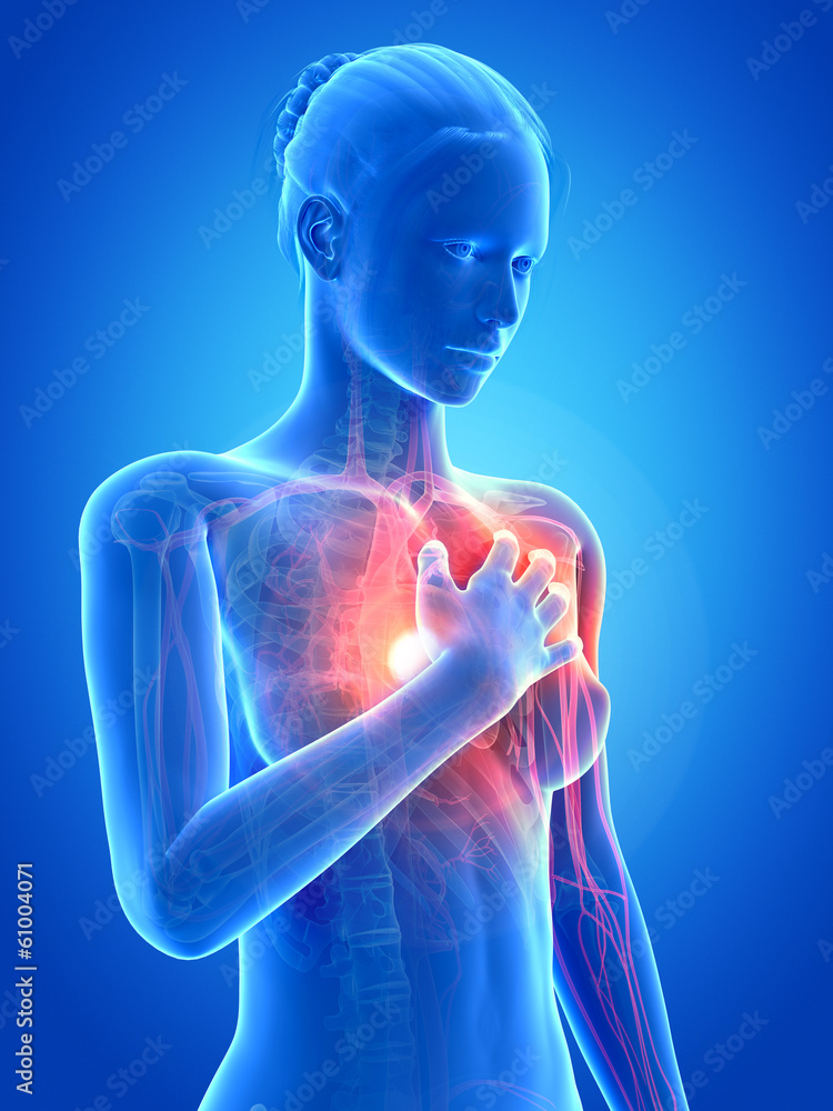 3d rendered illustration - female having a heart attack 3d rendered illustration - female having a heart attack