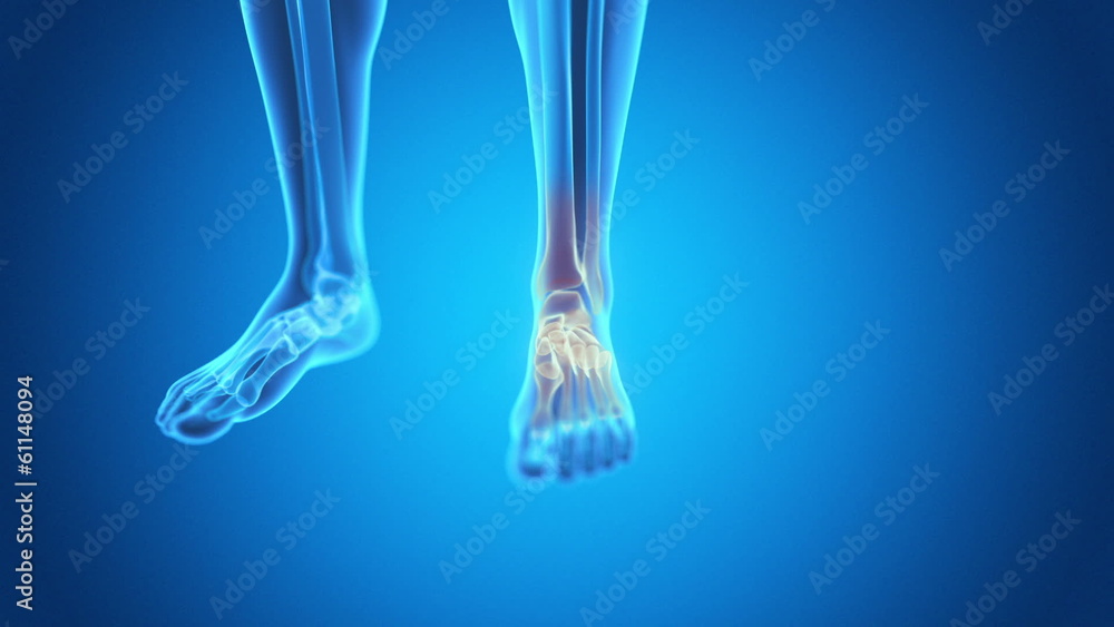 medical animation - pain in the foot medical animation - pain in the foot