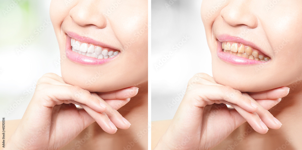Naklejka premium woman teeth before and after whitening