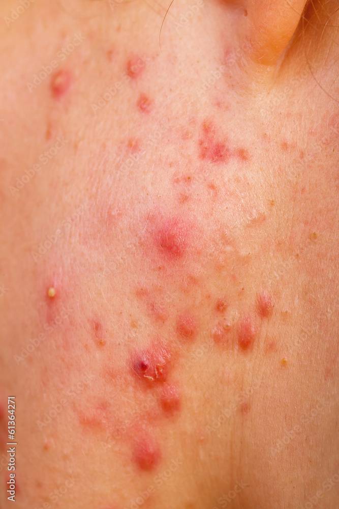 Fototapeta premium Acne skin