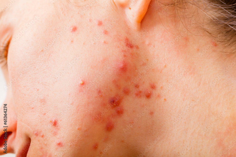 Fototapeta premium Acne skin