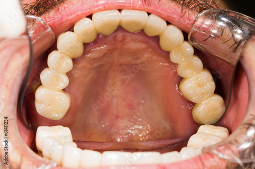 Dental Crowns and Bridges