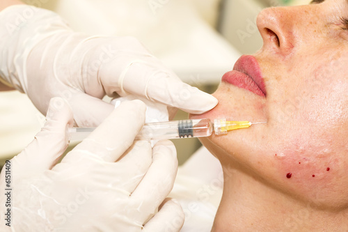 Close-up cosmetic treatment with syringe injection in a clinic