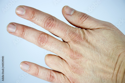 Amputated finger