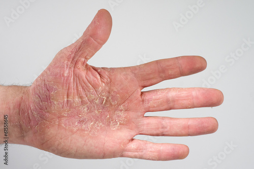 Foto linke Hand Neurodermitis 871