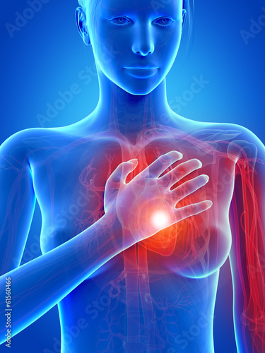 medical 3d illustration - heart attack