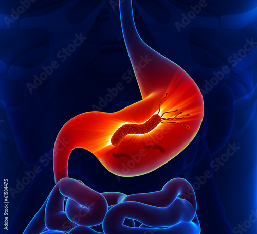 Helicobacter Pylori - Stomach