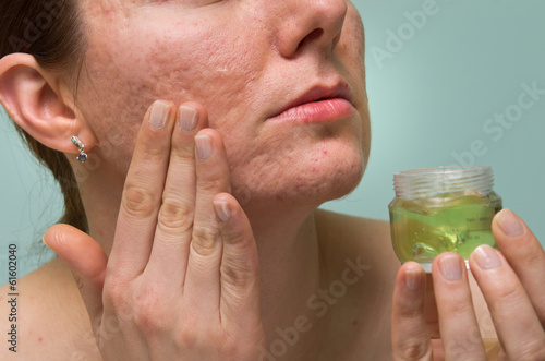 Acne therapy photo