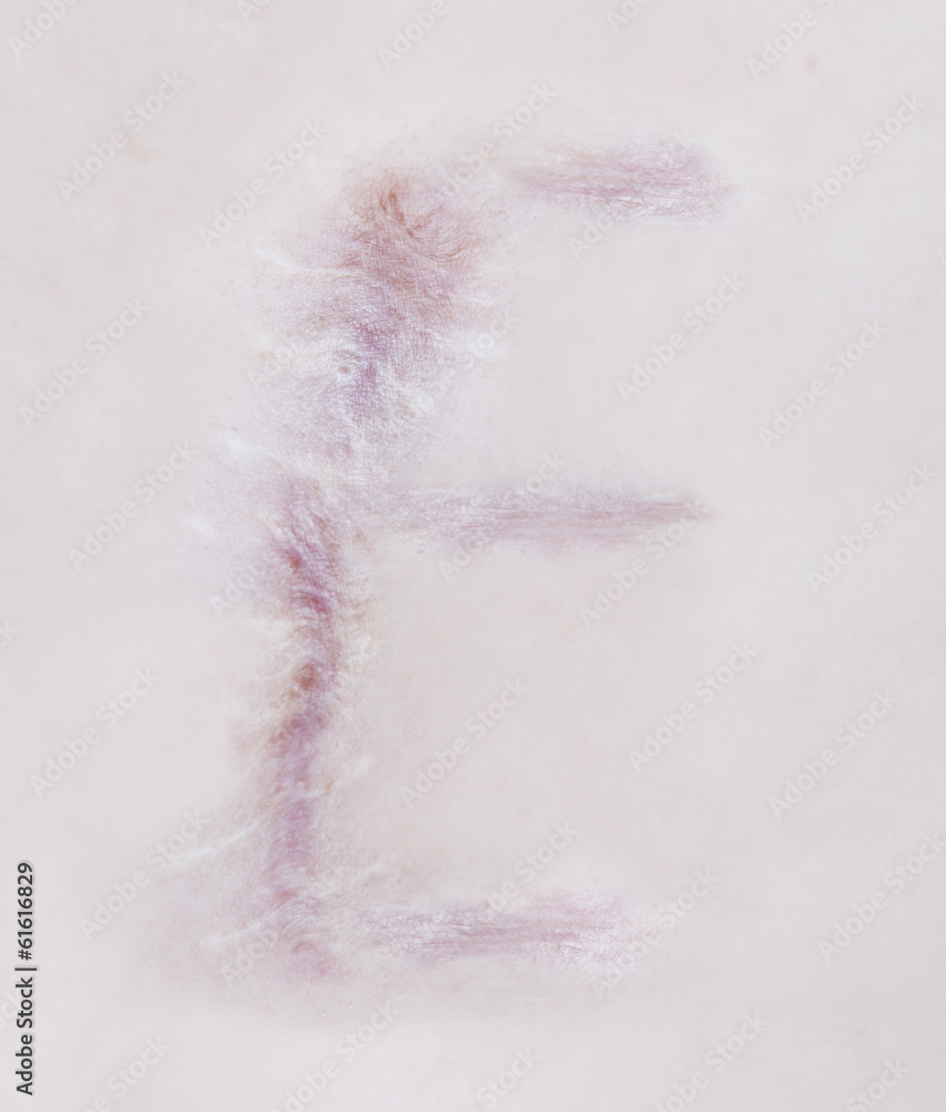Scar letter E on human skin