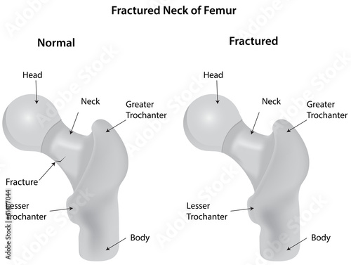 Fractured Neck of Femur