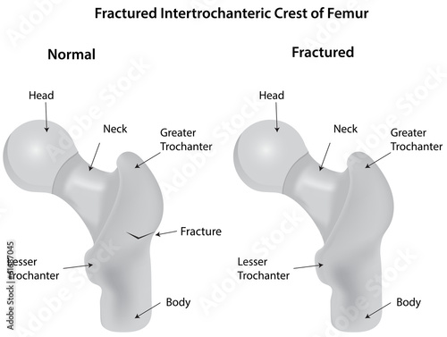 Fractured Intertrochanteric Crest of Femur