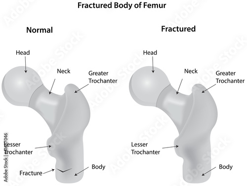 Fractured Body of Femur