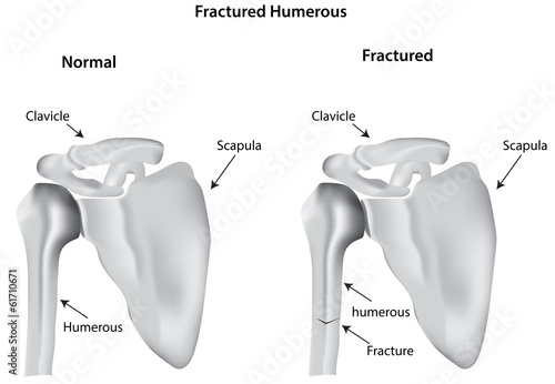 Fractured Humerous