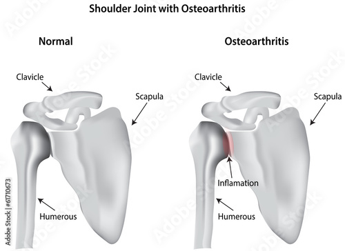 Shoulder with Osteoarthritis