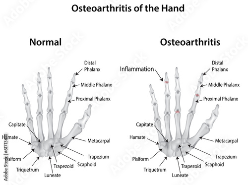 Osteoarthritis of the Hand