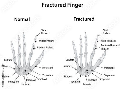 Fractured Finger