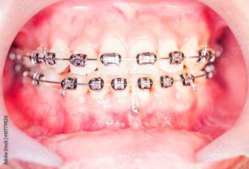 Close-up orthodontics braces with miniscrew.