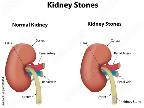 Kidney Stones