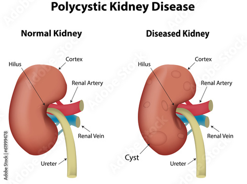 Poly cystic Kidney Disease