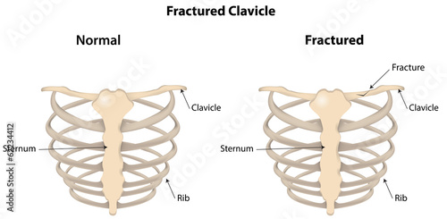 Fractured Clavicle Labeled Diagram