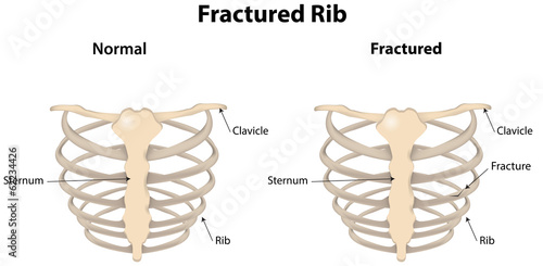 Fractured Rib Labeled Diagram