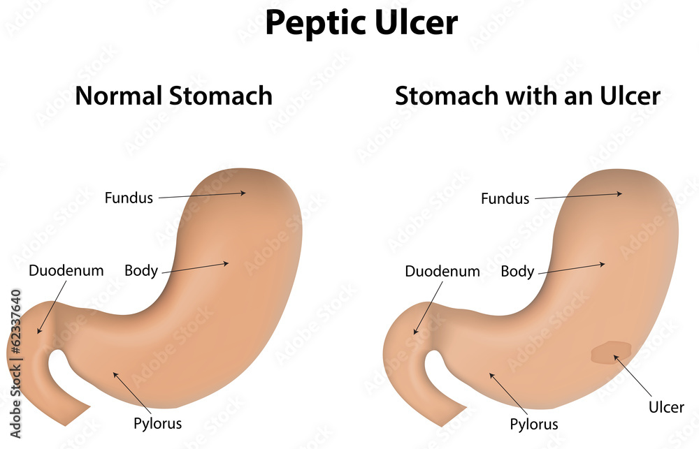 Peptic Ulcer Labeled Diagram Stomach Stock Vector | Adobe Stock