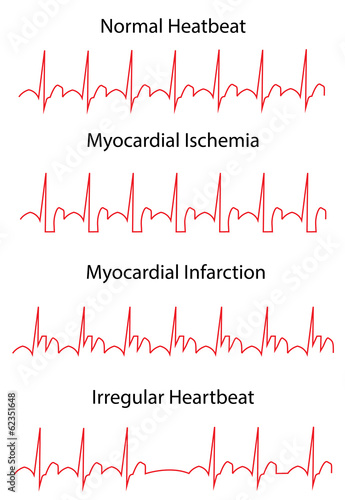 EKG Traces of Normal and Pathologies