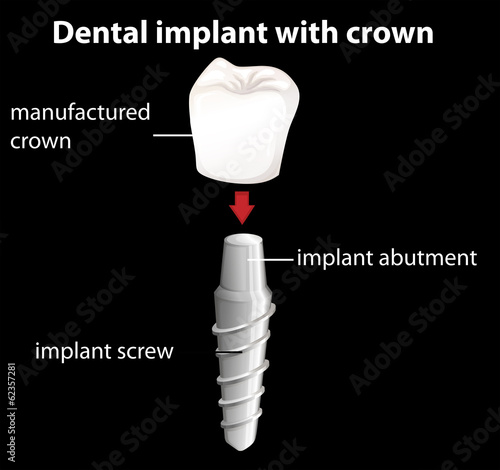 A dental implant with crown