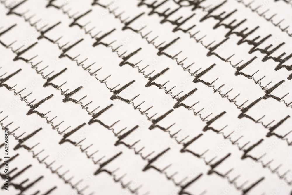 Fototapeta premium Extrasystoles On Electrocardiogram Record Paper