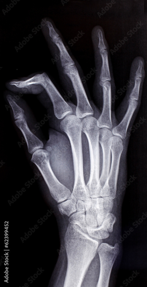 Xray of Hand Xray of Hand