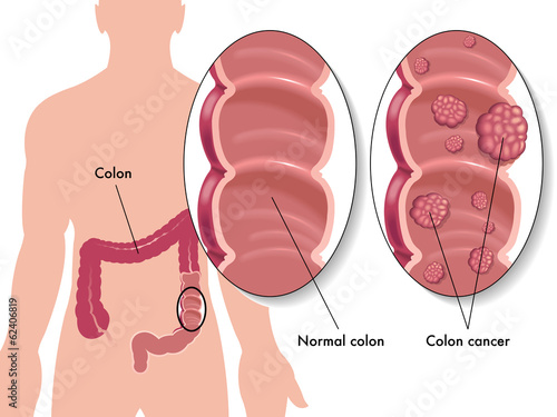 cancro del colon