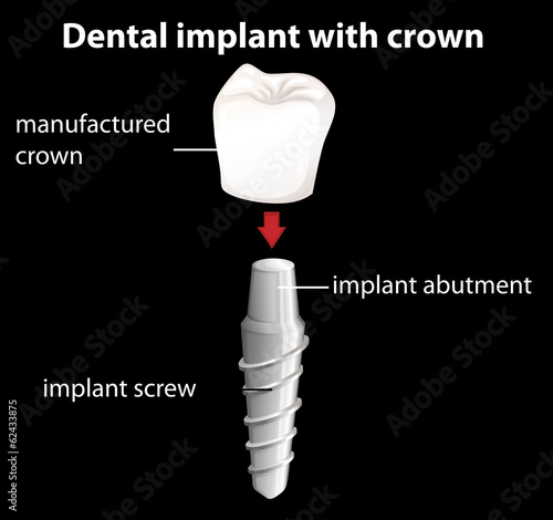 A dental implant with crown