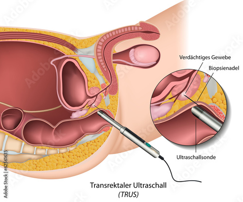 Transrektaler Ultraschall (TRUS)