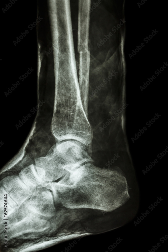 fracture shaft of fibula(leg's bone) with cast