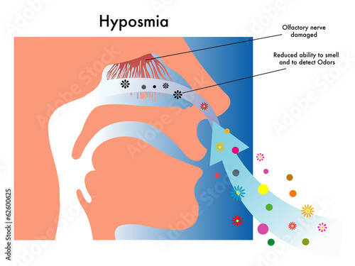 Iposmia