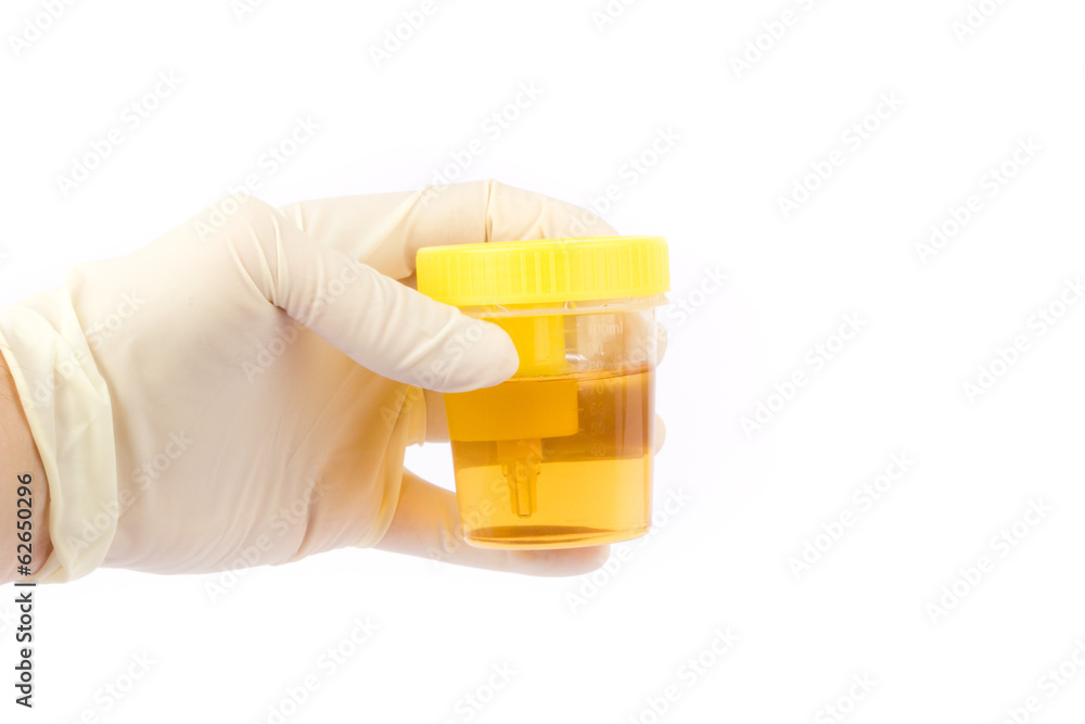 © tomschoumakers - Hand holding an urine sample © tomschoumakers - Hand holding an urine sample