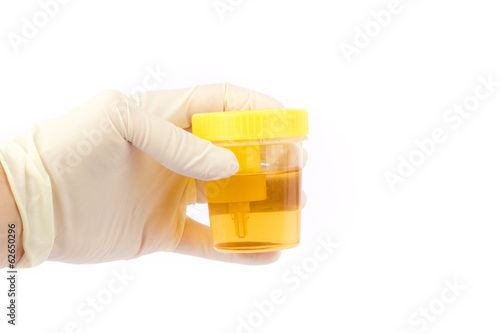 Hand holding an urine sample