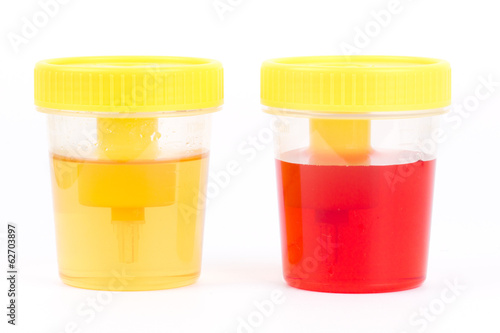Normal and bloody urine