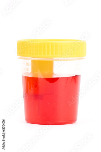 Bloody urine