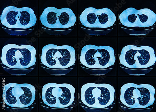 MRI scan of the human Lungs