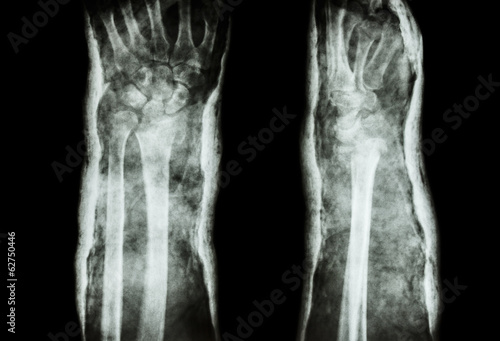 fracture distal radius (Colles' fracture) and cast
