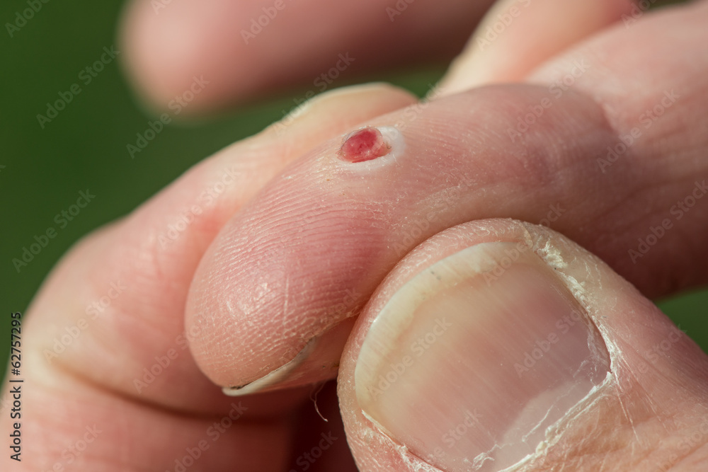 Pyogenic granuloma wound on a finger Stock Photo Adobe Stock