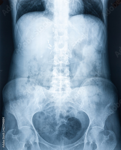 Xray of a human abdomen