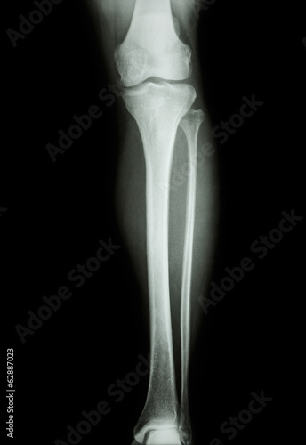 film x-ray normal human's leg